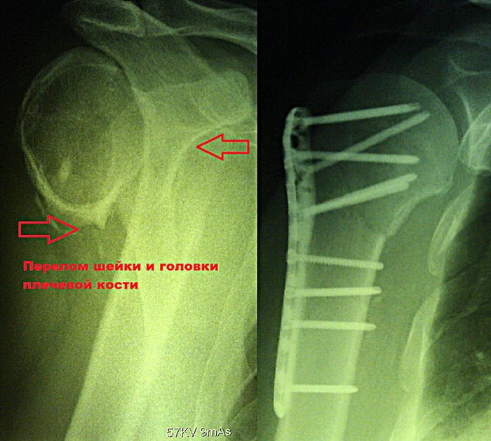 Удаление пластины при переломе плечевой кости