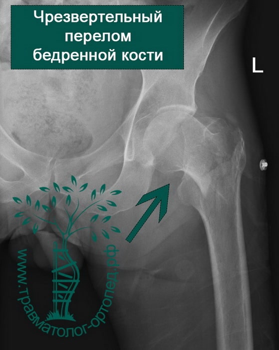 Чрезвертельный перелом бедренной кости рентген