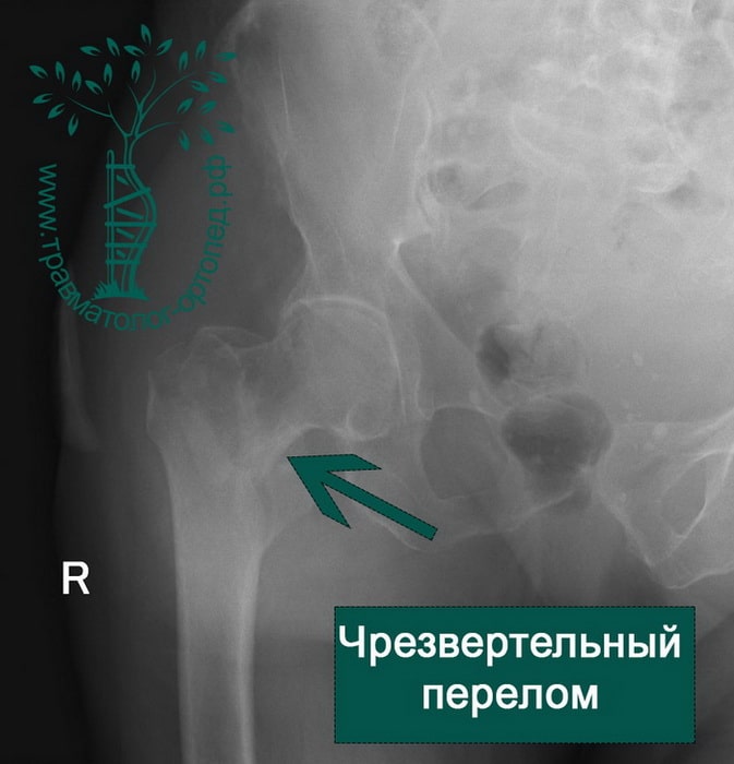 Остеосинтез чрезвертельного перелома бедренной кости
