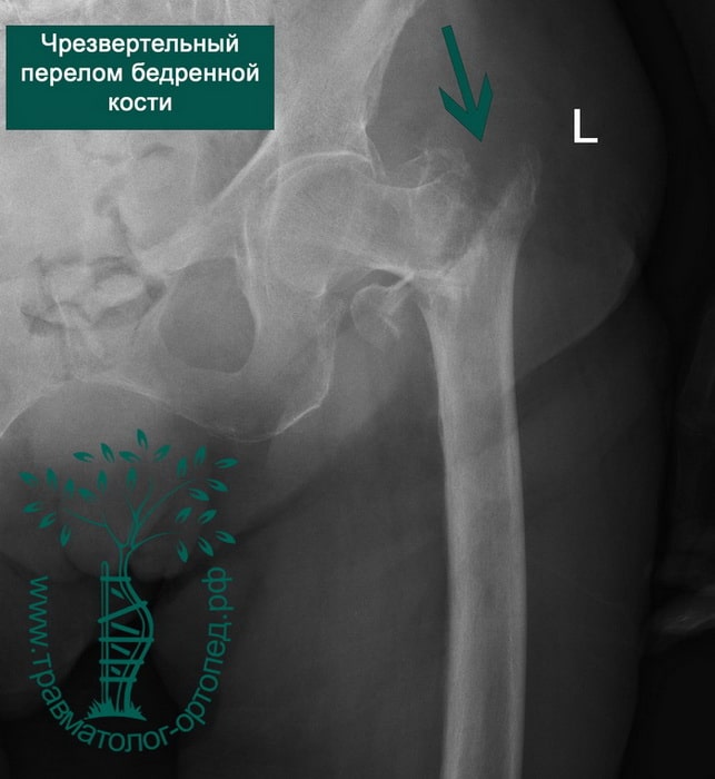 Чрезвертельный перелом бедренной кости рентген