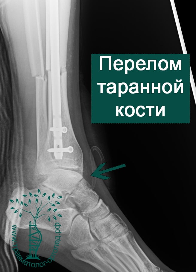 Голеностопный сустав перелом таранной кости