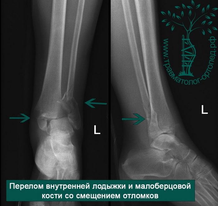 Перелом внешней лодыжки ноги