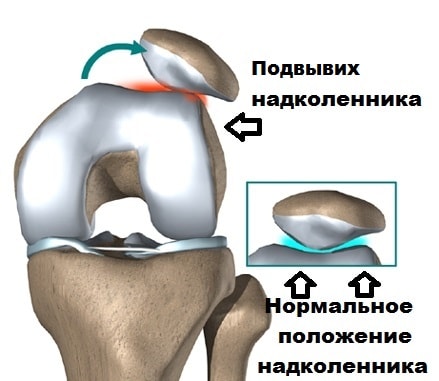 Вывих коленного сустава нестабильность коленного сустава