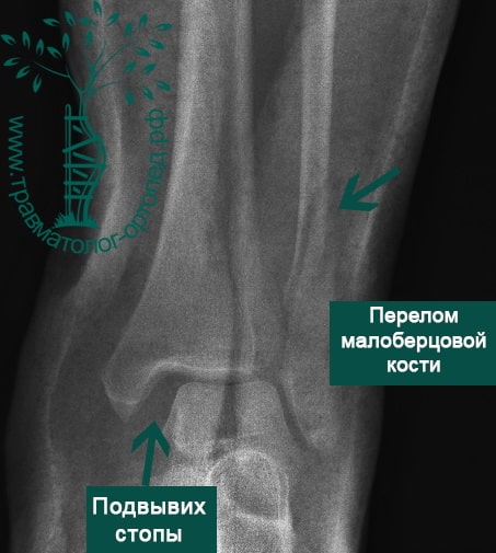 Перелом внешней лодыжки ноги