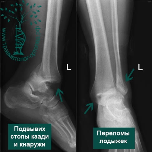 Фото перелома ноги рентген