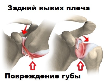 Задний вывих плеча механизм