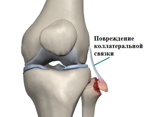 Дегенеративные изменения крестообразных связок коленного сустава