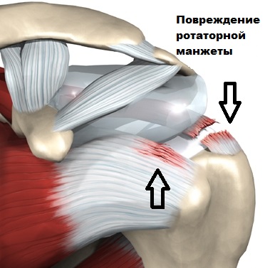 Растяжение манжеты плечевого сустава лечение