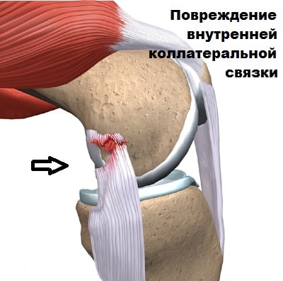 Лечение разрыва медиальной коллатеральной связки коленного сустава