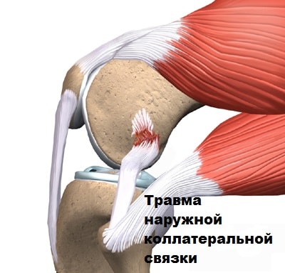 Лечение разрыва коллатеральных связок коленного сустава