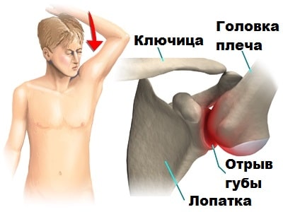 Симптомы заднего вывиха плеча