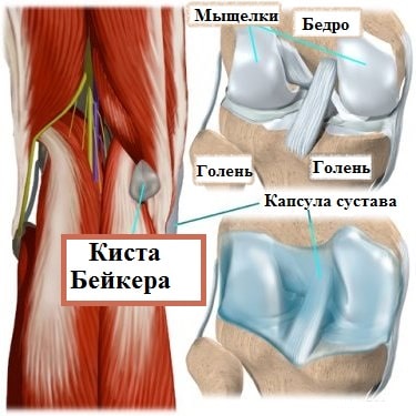 Киста коленного сустава лечение в москве