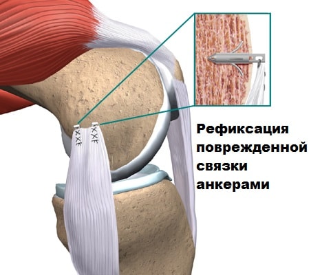 Растяжение коллатеральной связки коленного сустава лечение