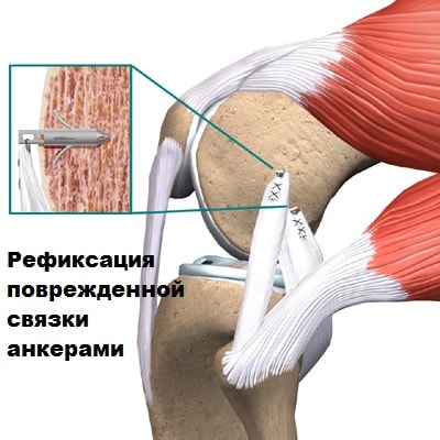 Коллатеральные связки коленного сустава на мрт