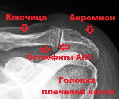 Деформирующий артроз акс плечевого сустава thumbnail