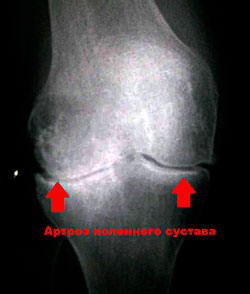 Гонартроз коленного сустава стоимость лечения