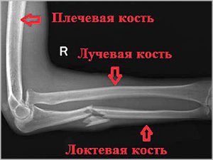 Мкб 10 перелом предплечья кости