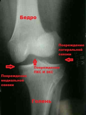 Повреждение коллатеральных связок коленного сустава симптомы и лечение