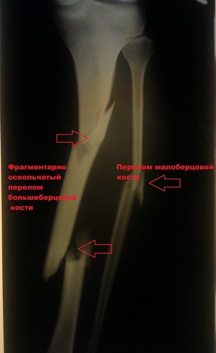 Перелом ноги установка стержня