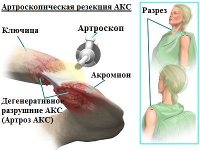 Артроз акс плечевого сустава