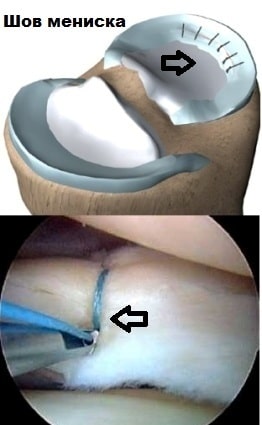 Артроскопическое лечение повреждения мениска коленного сустава