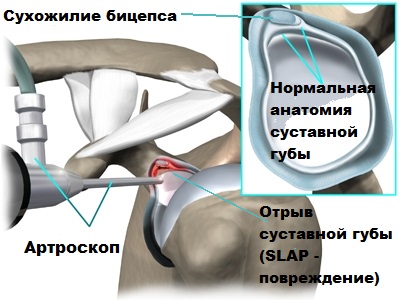 Синдром плечевой щеколды при травме