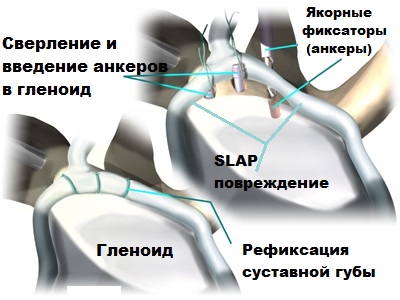 Slap синдром плечевого сустава лечение
