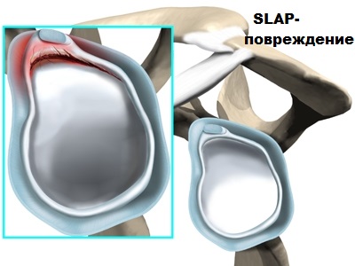 Slap повреждение плечевого сустава лечение