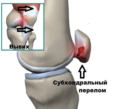Операция при вывихе коленной чашки