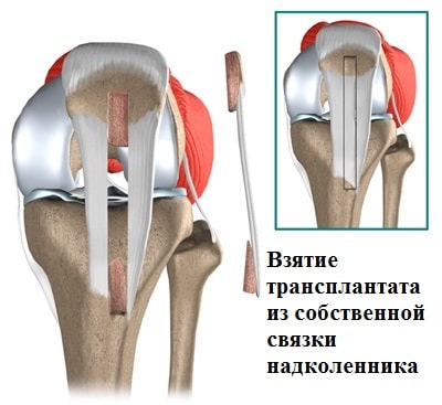 Задняя крестообразная связка коленного сустава лечение