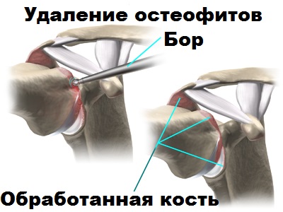 Артроз плечевого сустава ортопед thumbnail