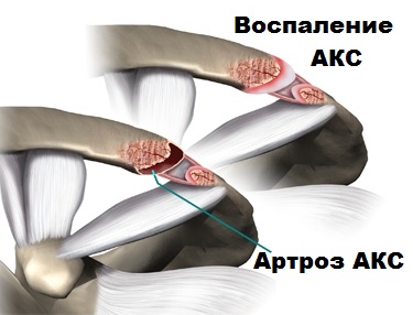 Деформирующий артроз акс плечевого сустава