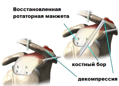 Лечение повреждений вращательной манжеты правого плечевого сустава