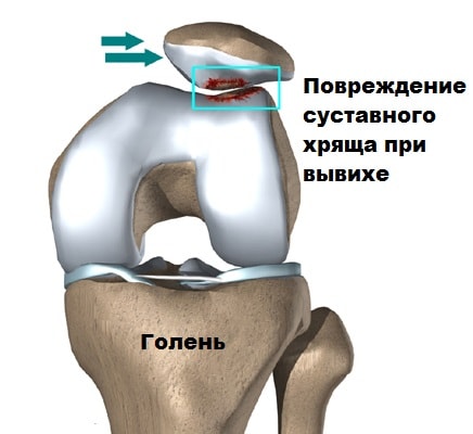 Вывих коленного сустава нестабильность коленного сустава