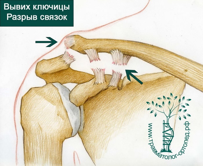Вывих сустава закрытый перелом разрыв сухожилия. Перелом акс плечевого сустава. Неполный вывих акромиального конца ключицы. Разрыв связок плечевого сустава акс.