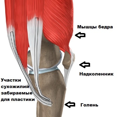 Повреждение задней связки коленного сустава лечение