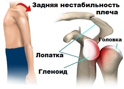 Плечевой сустав задний вывих