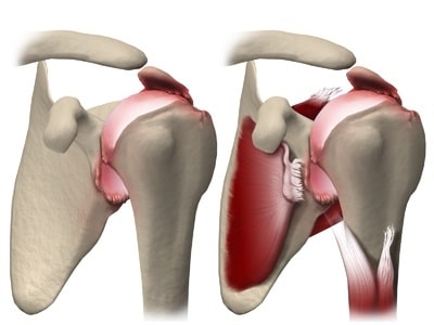 Эндопротезы плечевого сустава цито
