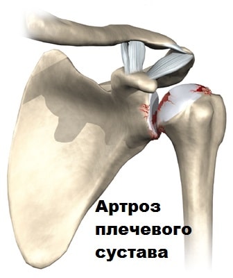 Эндопротезирование плечевого сустава артроз