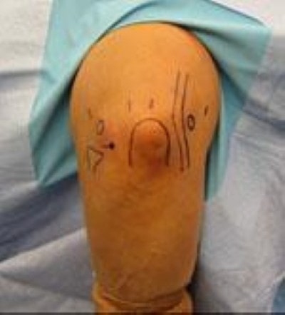 Артроскопия локтевого сустава реабилитация thumbnail