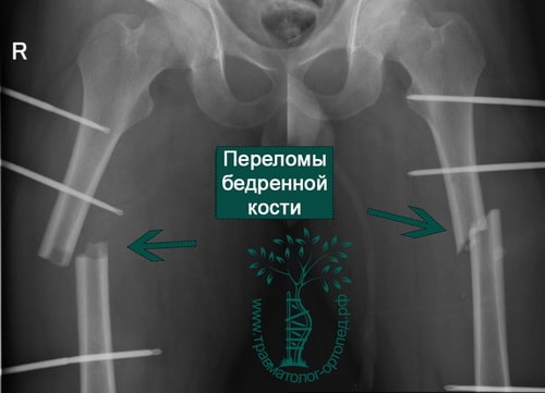 Фиксация при переломе бедренной кости