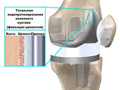 Эндопротезирование коленного сустава что делать после