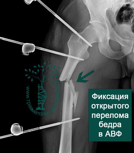 Операция при переломе костей бедра