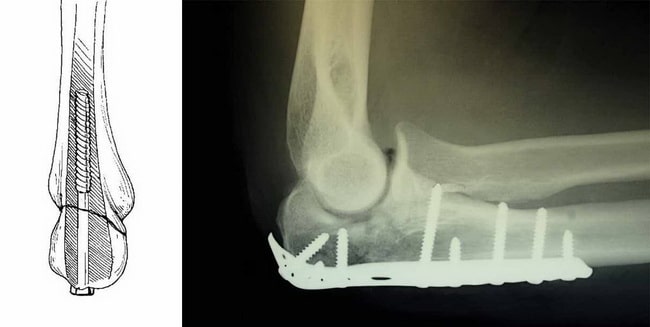 Перелом венечного отростка локтевой кости рентген thumbnail