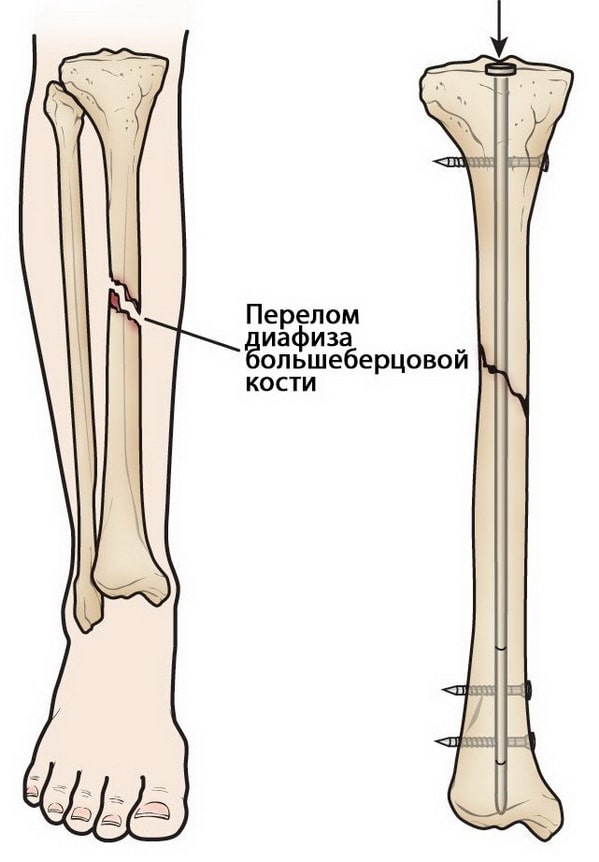 Перелом диафиза большеберцовой кости в нижней трети