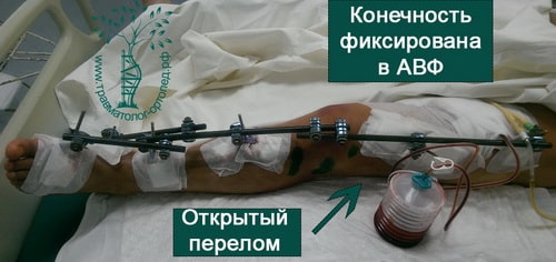 Материалы для операции перелома бедра