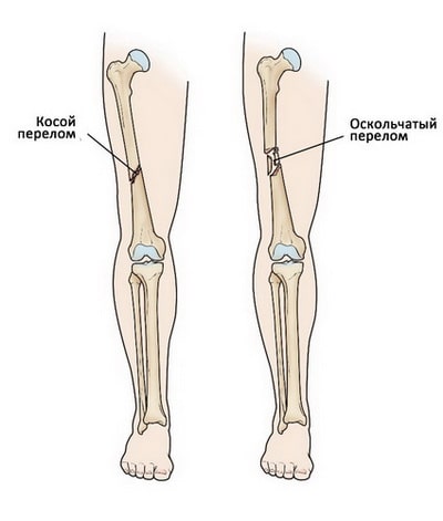 Перелом бедра левой ноги