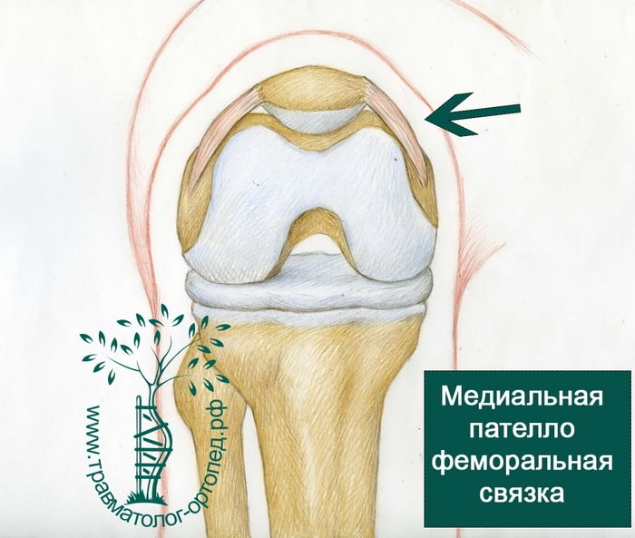 Вывих надколенника или коленной чашечки: лечение и реабилитация, последствия