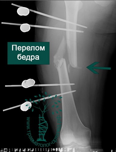 Перелом ноги выше колена