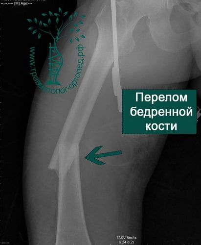 Фиксация при переломе бедренной кости